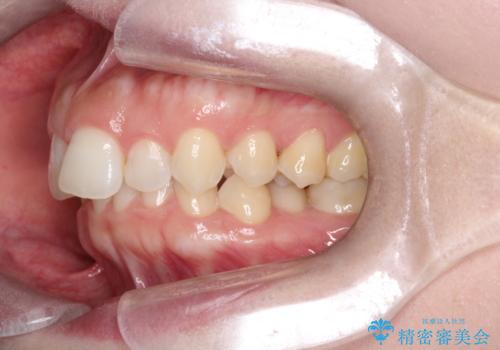 【インビザライン】前歯の凸凹を治したい。の治療前