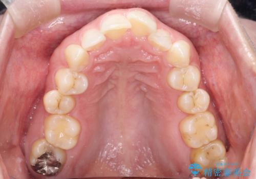 【インビザライン】前歯の凸凹を治したい。の治療前