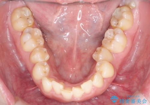 【インビザライン】前歯の凸凹を治したい。の治療前