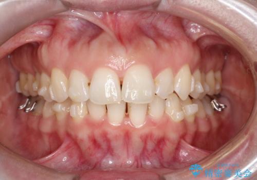 【インビザライン】前歯の凸凹を治したい。の治療中