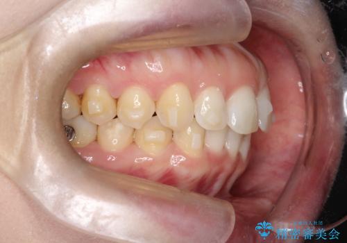 【インビザライン】前歯の凸凹を治したい。の治療中