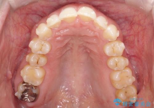 【インビザライン】前歯の凸凹を治したい。の治療中