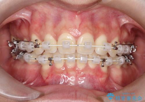 【審美ワイヤー】口元を下げたいの治療中