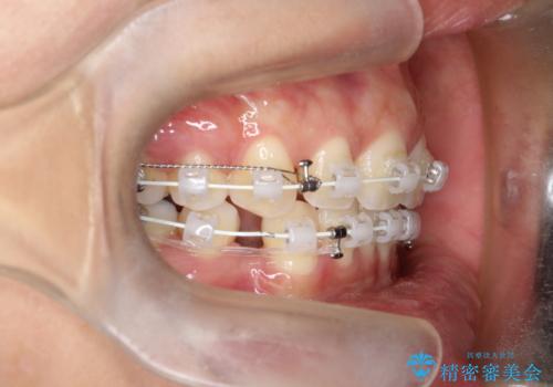 【審美ワイヤー】口元を下げたいの治療中