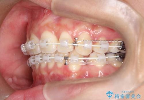 【審美ワイヤー】口元を下げたいの治療中
