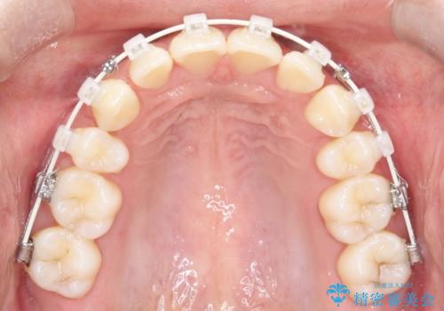 【審美ワイヤー】口元を下げたいの治療中