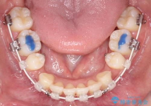 【審美ワイヤー】口元を下げたいの治療中