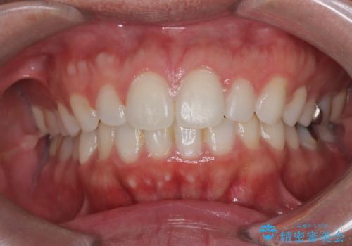 【前突症例】前歯を下げたいの症例 治療後