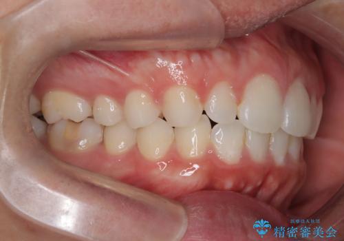 【前突症例】前歯を下げたいの治療後