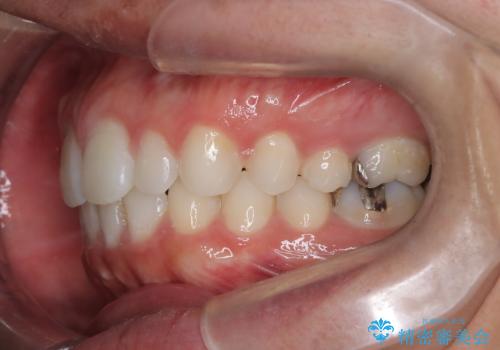 【前突症例】前歯を下げたいの治療後