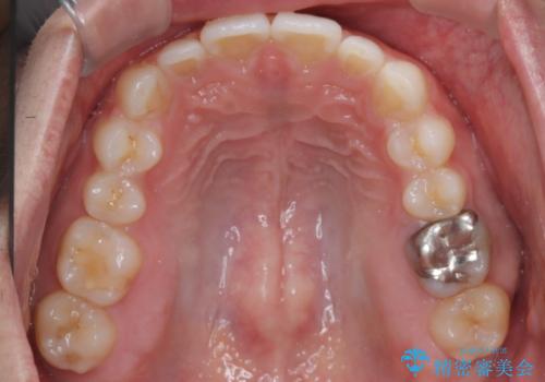 【前突症例】前歯を下げたいの治療後