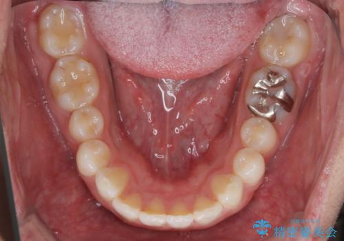 【前突症例】前歯を下げたいの治療後