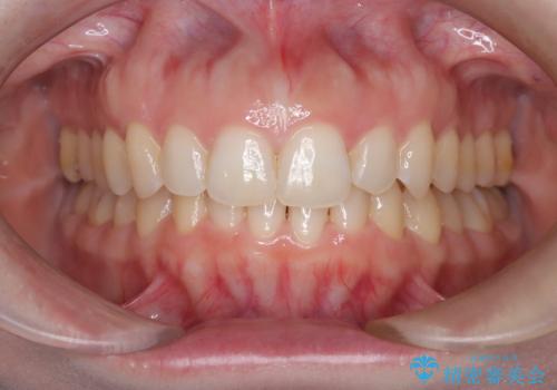 【インビザライン】前歯の凸凹を治したい。の治療後