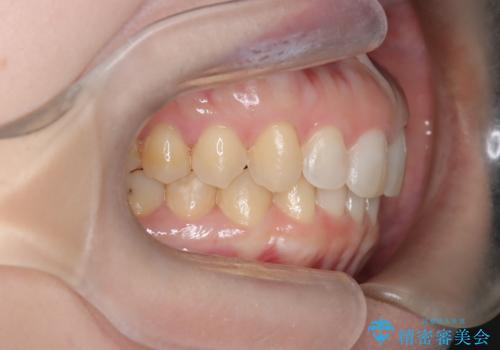 【インビザライン】前歯の凸凹を治したい。の治療後