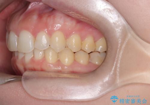 【インビザライン】前歯の凸凹を治したい。の治療後