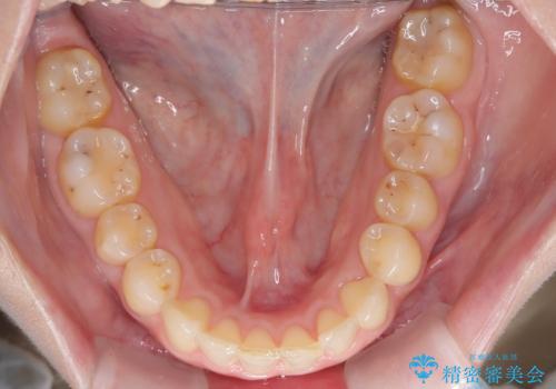 【インビザライン】前歯の凸凹を治したい。の治療後