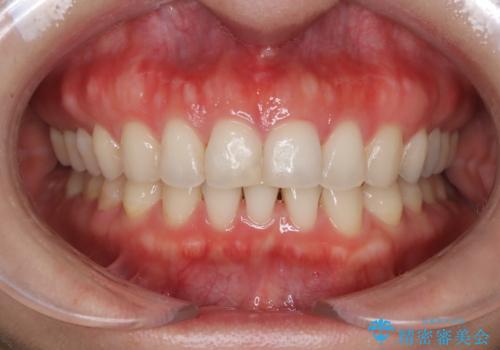 【下顎前歯の抜歯矯正】マウスピース矯正の症例 治療後