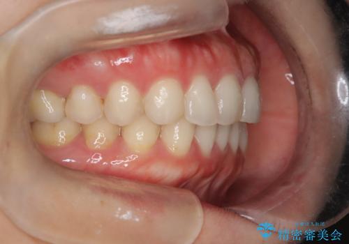 【下顎前歯の抜歯矯正】マウスピース矯正の治療後