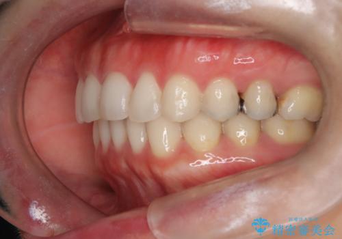【下顎前歯の抜歯矯正】マウスピース矯正の治療後