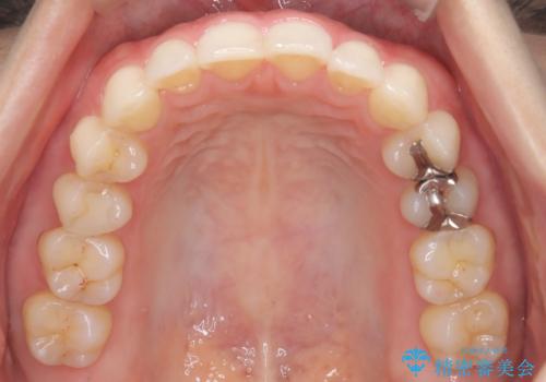 【下顎前歯の抜歯矯正】マウスピース矯正の治療後