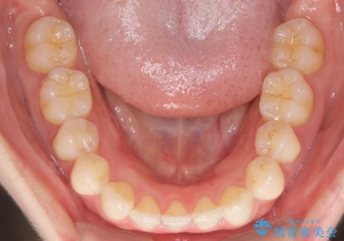 【下顎前歯の抜歯矯正】マウスピース矯正の治療後