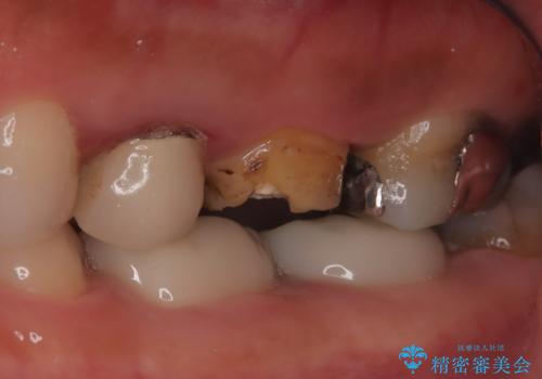 【破折ファイル除去】他院で折れた根管治療の器具をとってほしいの治療前