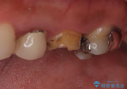 【破折ファイル除去】他院で折れた根管治療の器具をとってほしいの治療前