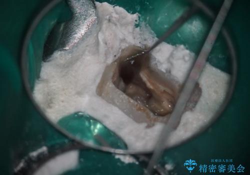 【破折ファイル除去】他院で折れた根管治療の器具をとってほしい