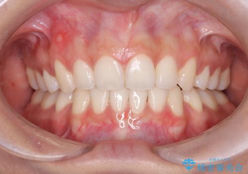 【審美ワイヤー】口元を下げたいの症例 治療後