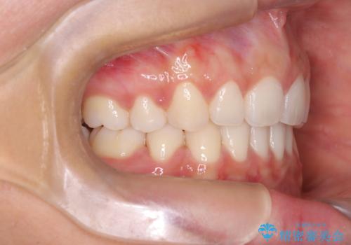 【審美ワイヤー】口元を下げたいの治療後