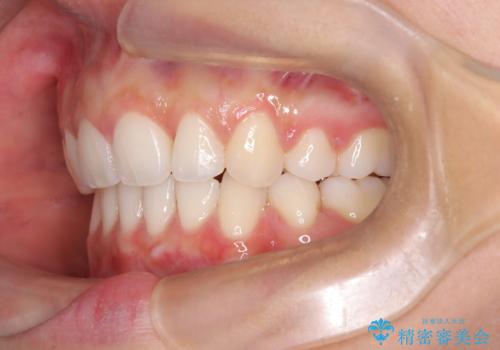 【審美ワイヤー】口元を下げたいの治療後