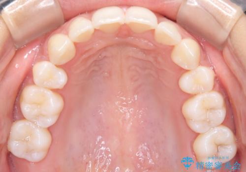 【審美ワイヤー】口元を下げたいの治療後