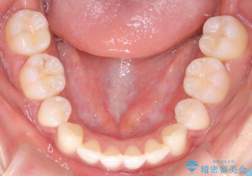 【審美ワイヤー】口元を下げたいの治療後