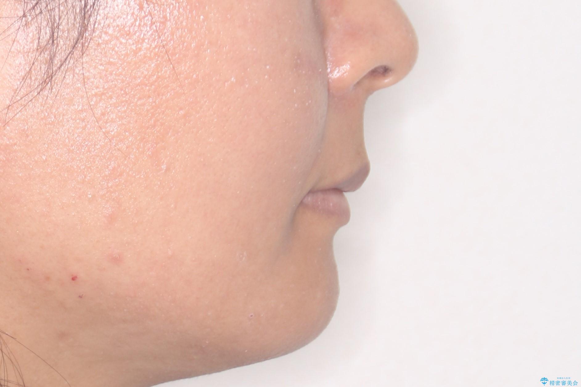 【審美ワイヤー】口元を下げたいの治療後(顔貌)