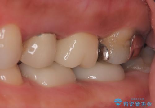 【破折ファイル除去】他院で折れた根管治療の器具をとってほしいの治療後