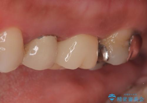 【破折ファイル除去】他院で折れた根管治療の器具をとってほしいの治療後