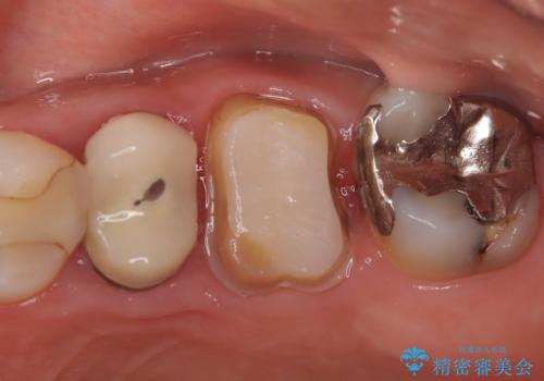 【破折ファイル除去】他院で折れた根管治療の器具をとってほしいの治療中