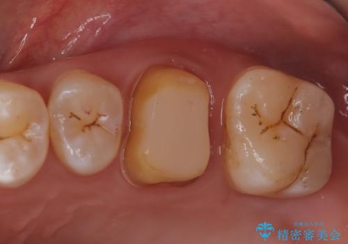 【見逃し根管を発見】根管治療〜セラミッククラウンの治療中