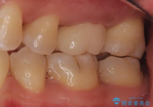 【見逃し根管を発見】根管治療〜セラミッククラウンの治療後