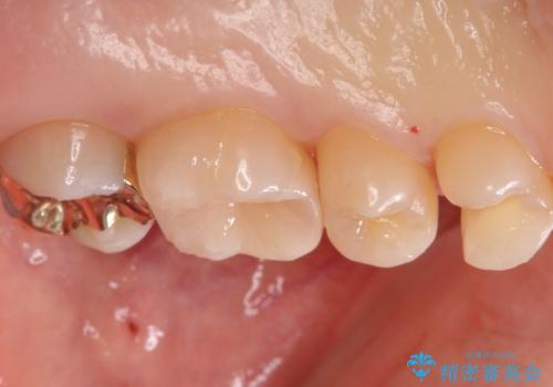 歯と歯の間の虫歯　インレーでの治療(セラミック・ゴールド)の治療中
