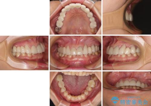 割れてしまった歯が痛む 矯正とインプラントを併用した総合歯科治療の治療後