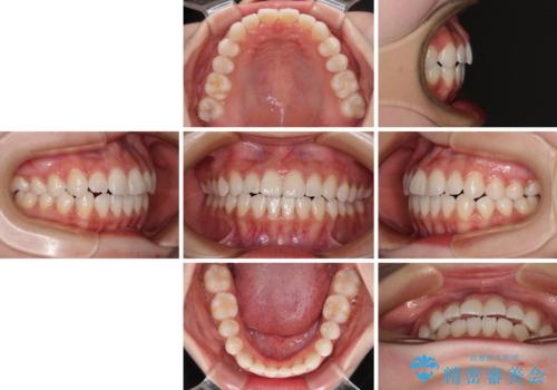 隙間が空いてデコボコした前歯を治したい ワイヤー装置による矯正治療の治療後