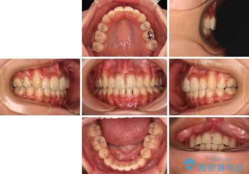 八重歯と出っ歯を治したい ワイヤー装置での抜歯矯正の治療後
