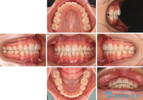 前歯のデコボコとクロスバイトを治したい ワイヤー装置による抜歯矯正の治療後