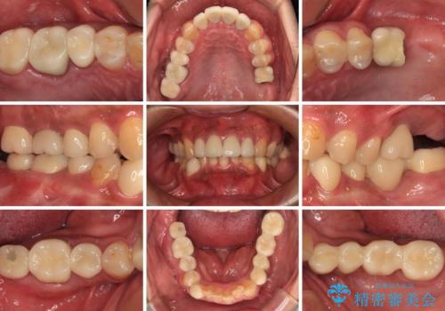 目立つ金属をすべてセラミックに 全顎的メタルフリー治療の治療後