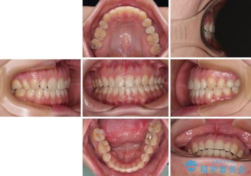 隙間の空いた歯列とボロボロの乳歯 インプラント治療と矯正治療の治療後