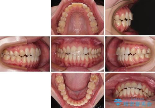 開咬を治す インビザラインによる矯正治療の治療後