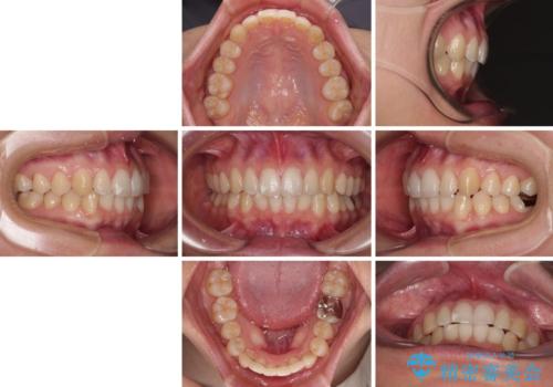 【モニター】前歯のデコボコとクロスバイト インビザラインによる矯正治療の治療前