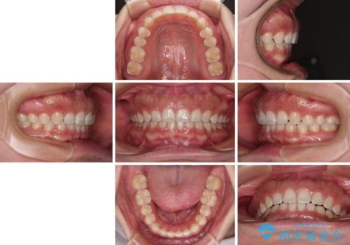 【モニター】ディープバイトを治す ワイヤー装置による矯正治療の治療後