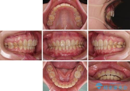 抜歯矯正で唇を閉じやすく ワイヤー矯正の治療後